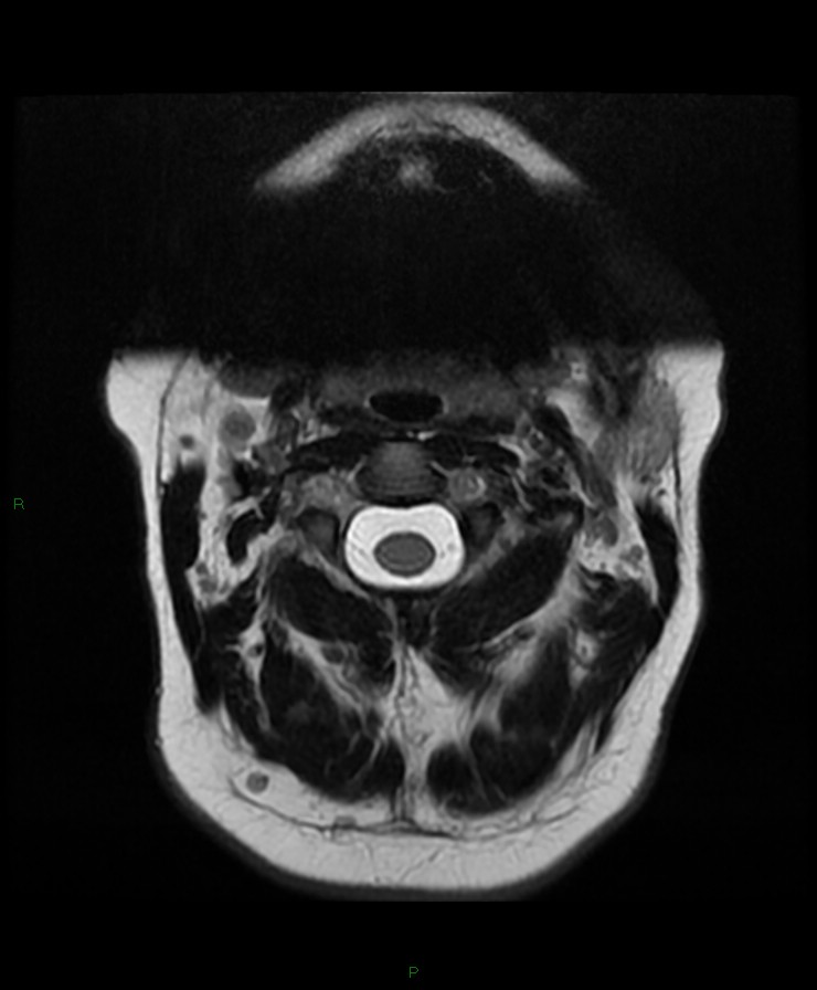 Normal cervical spine MRI (Radiopaedia 80146-93454 Axial T2 6).jpg
