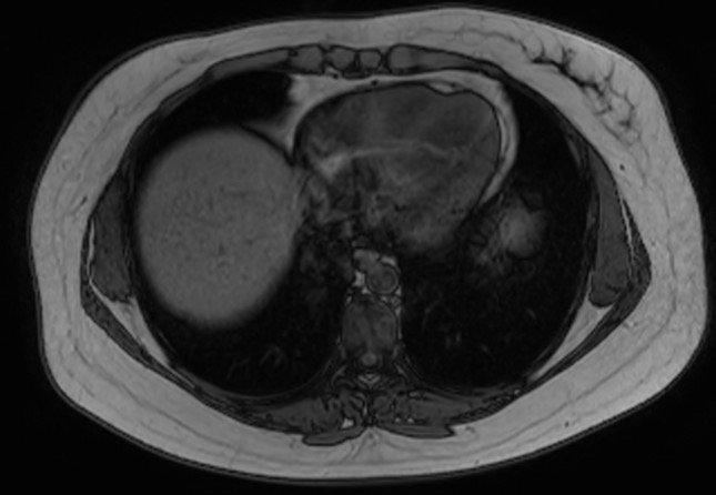 File:Normal liver MRI with Gadolinium (Radiopaedia 58913-66163 B 30).jpg