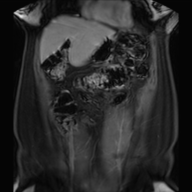 Normal liver MRI with Gadolinium (Radiopaedia 58913-66163 P 23).jpg