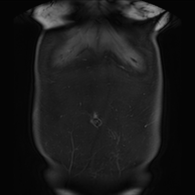 Normal liver MRI with Gadolinium (Radiopaedia 58913-66163 P 8).jpg