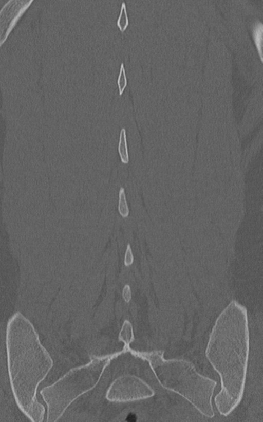 Normal lumbar spine CT (Radiopaedia 46533-50986 Coronal bone window 66).png