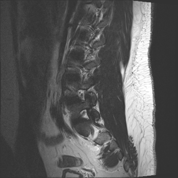 File:Normal lumbar spine MRI (Radiopaedia 47857-52609 Sagittal T2 4).jpg