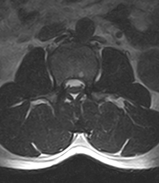 Normal lumbar spine MRI - low-field MRI scanner (Radiopaedia 40976-43699 Axial T2 38).jpg