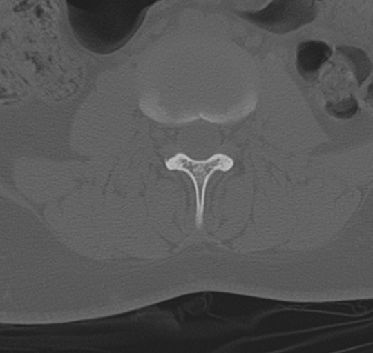 File:Normal lumbosacral CT (Radiopaedia 37923-39867 Axial bone window 55).png