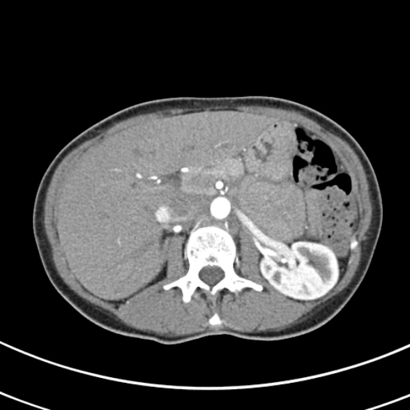 File:Normal multiphase CT liver (Radiopaedia 38026-39996 B 28).jpg
