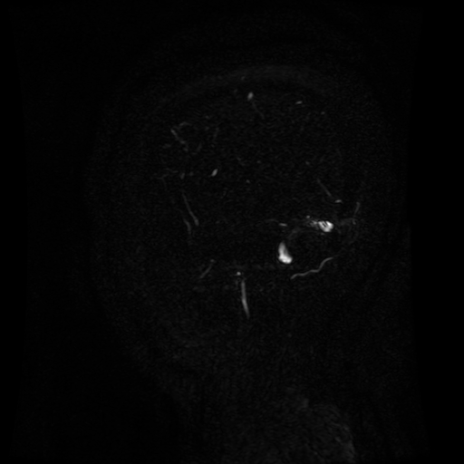 Normal noncontrast MR venography (Radiopaedia 87578-103957 A 147).jpg