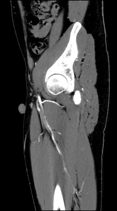Normal pelvis CT angiogram (Radiopaedia 84966-100481 C 80).jpg