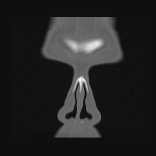Normal sinus CT (annotated) (Radiopaedia 78917-91810 Coronal bone window 11).jpg