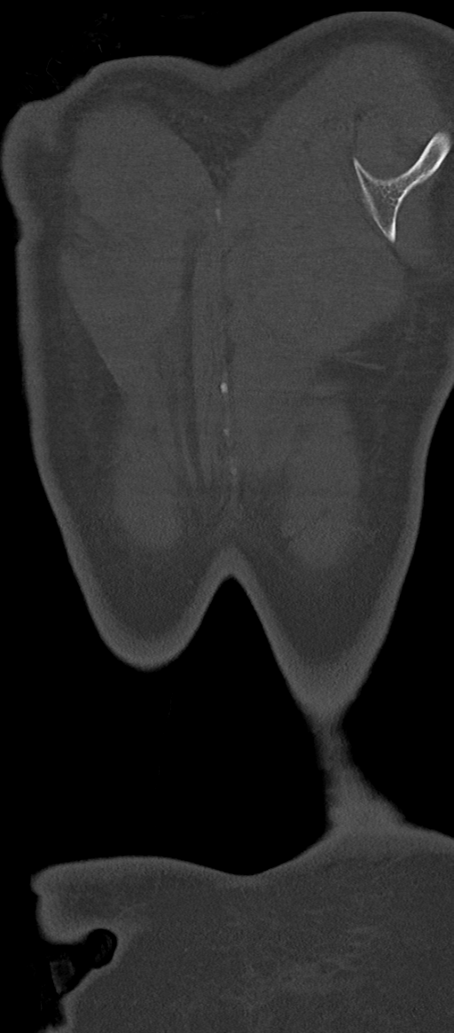 Normal thoracolumbar spine (Radiopaedia 43822-47309 Coronal bone window 92).png