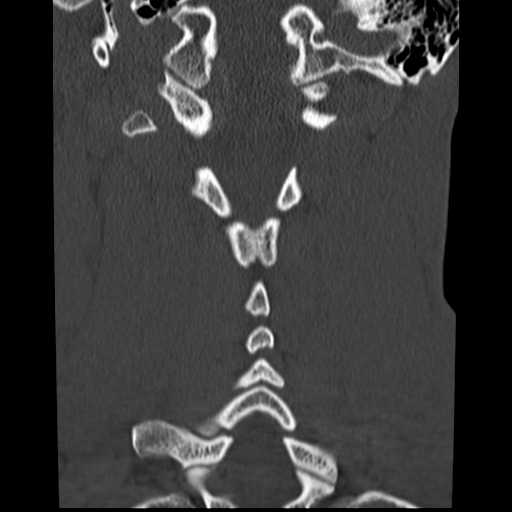 File:Normal trauma cervical spine (Radiopaedia 41017-43760 Coronal bone window 27).png