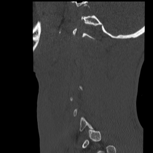 File:Normal trauma cervical spine (Radiopaedia 41017-43760 Sagittal bone window 41).png