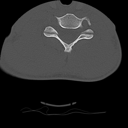 Normal trauma spine imaging (age 16) (Radiopaedia 45335-49358 Axial bone window 56).jpg