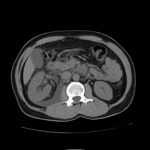 File:Obstructed kidney with perinephric urinoma (Radiopaedia 26889-27066 Axial non-contrast 20).jpg