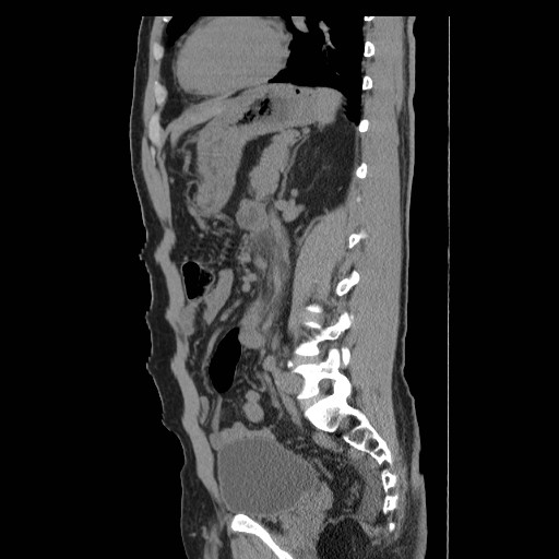 File:Obstructed kidney with perinephric urinoma (Radiopaedia 26889-27066 B 43).jpg