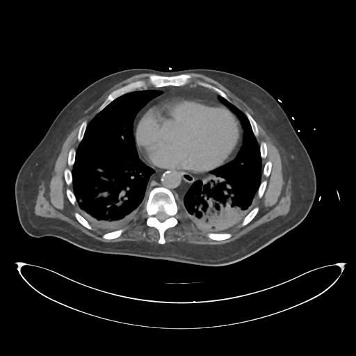 File:Obstructive pyelonephritis (Radiopaedia 46411-50844 Axial non-contrast 6).png