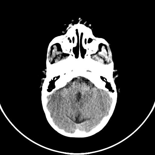 Occipital encephalocele (Radiopaedia 87339-103636 Axial non-contrast 25).jpg