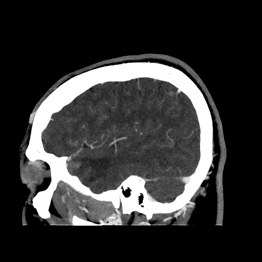 Occipital extradural hematoma simulating venous sinus thrombosis (Radiopaedia 46514-50964 D 61).jpg