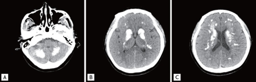 a-c)Brain computed tomography shows diffuse symmetric parenchymal calcifications