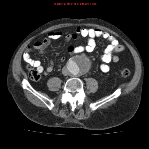 Abdominal aortic aneurysm (Radiopaedia 10122-10660 Axial C+ portal venous phase 50).jpg