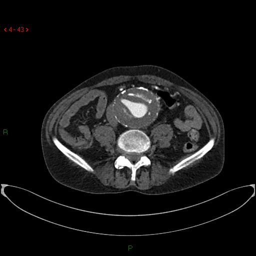 File:Abdominal aortic aneurysm (Radiopaedia 16155-15834 Axial C+ arterial phase 23).jpg