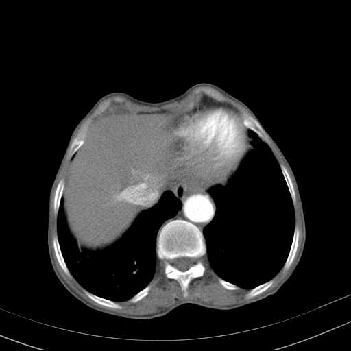 File:Abdominal aortic aneurysm (Radiopaedia 20827-20742 Axial C+ arterial phase 4).jpg