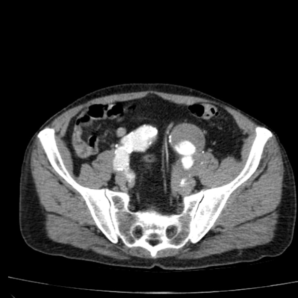 Abdominal aortic aneurysm (Radiopaedia 29248-29660 Axial C+ arterial phase 68).jpg