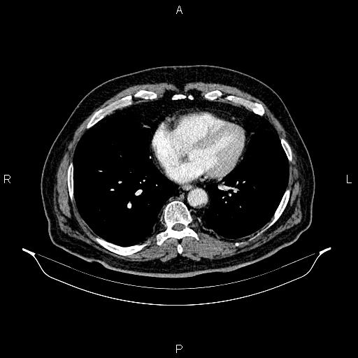 Abdominal aortic aneurysm (Radiopaedia 83094-97462 Axial renal cortical phase 50).jpg