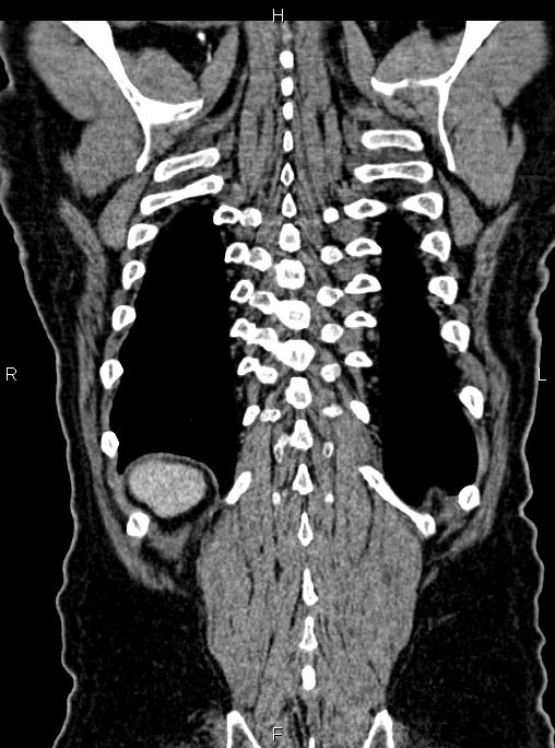 Abdominal aortic aneurysm (Radiopaedia 83094-97462 Coronal renal cortical phase 80).jpg