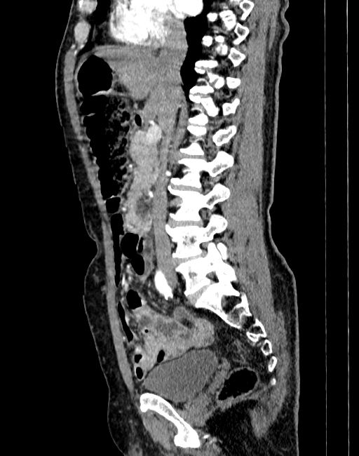 Abdominal aortic aneurysm (Radiopaedia 83581-98689 Sagittal C+ arterial phase 30).jpg