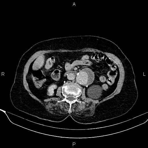 Abdominal aortic aneurysm (Radiopaedia 85063-100606 Axial C+ delayed 54).jpg