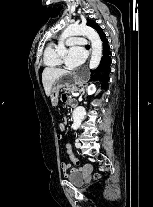 Abdominal aortic aneurysm (Radiopaedia 85063-100606 Sagittal C+ arterial phase 48).jpg