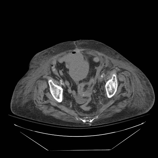 Abdominal aortic aneurysm - impending rupture (Radiopaedia 19233-19247 Axial non-contrast 142).jpg