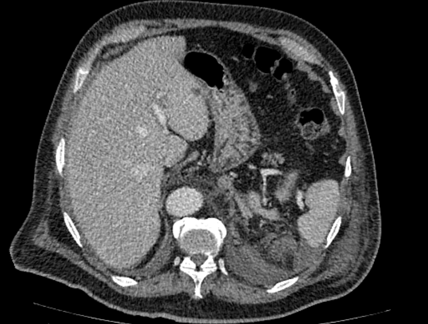 Abdominal aortic aneurysm rupture (Radiopaedia 54179-60362 Axial C+ portal venous phase 32).jpg