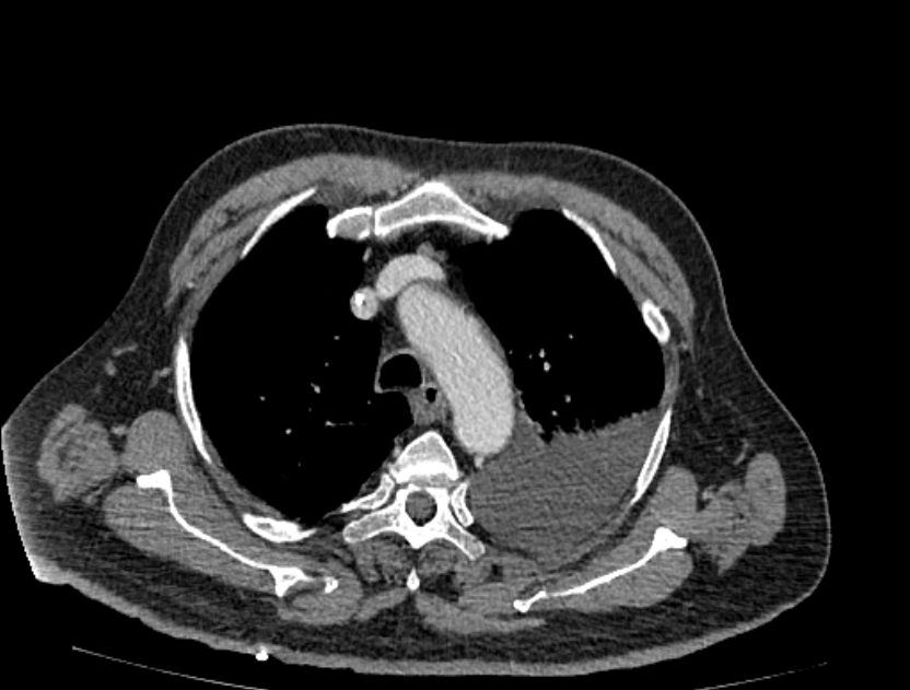 Abdominal aortic aneurysm rupture (Radiopaedia 54179-60362 Axial C+ portal venous phase 49).jpg