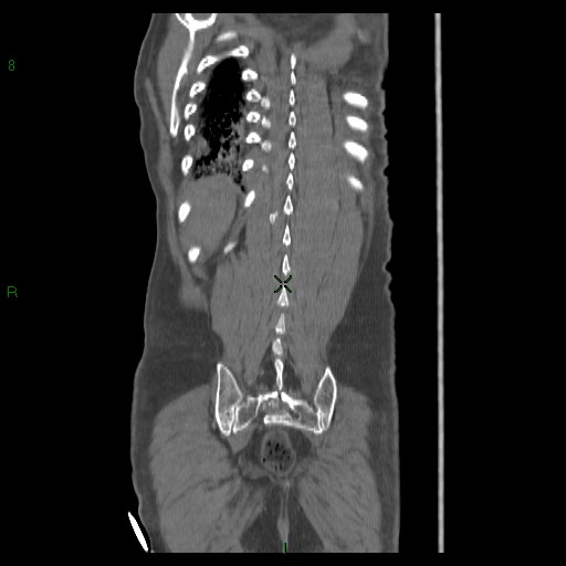File:Abdominal aortic aneurysm rupture with aortocaval fistula (Radiopaedia 14897-14841 Coronal C+ arterial phase 37).jpg