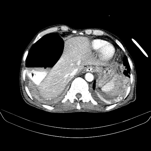File:Abdominal collection due to previous cecal perforation (Radiopaedia 80831-94320 Axial C+ portal venous phase 26).jpg