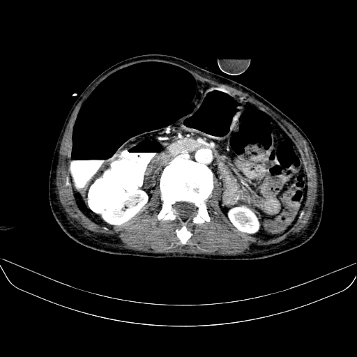 File:Abdominal collection due to previous cecal perforation (Radiopaedia 80831-94320 Axial C+ portal venous phase 93).jpg