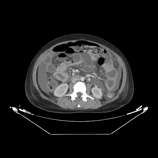 Abdominal gossypiboma- surgical towel (Radiopaedia 57288-64226 Axial C+ portal venous phase 32).jpg