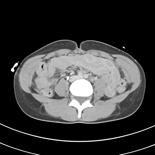 File:Abdominal multi-trauma - devascularised kidney and liver, spleen and pancreatic lacerations (Radiopaedia 34984-36486 Axial C+ delayed 47).png