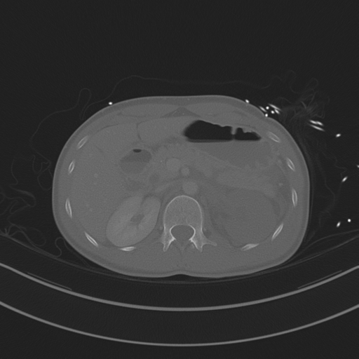 Abdominal multi-trauma - devascularised kidney and liver, spleen and pancreatic lacerations (Radiopaedia 34984-36486 Axial bone window 27).png