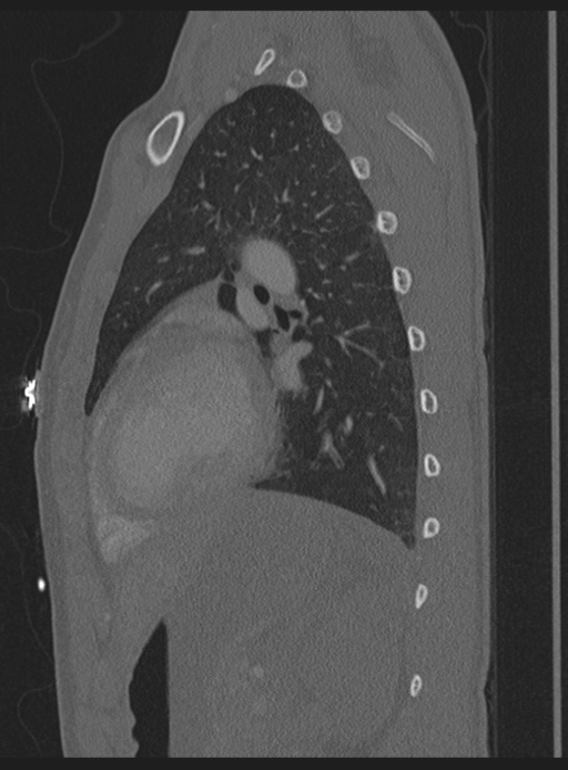 Abdominal multi-trauma - devascularised kidney and liver, spleen and pancreatic lacerations (Radiopaedia 34984-36486 Sagittal bone window 9).png