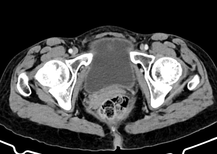 Abdominal wall and retroperitoneal tuberculosis (Radiopaedia 88137-104729 Axial C+ portal venous phase 185).jpg