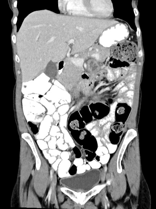 Abdominal wall and retroperitoneal tuberculosis (Radiopaedia 88137-104729 Coronal C+ portal venous phase 38).jpg