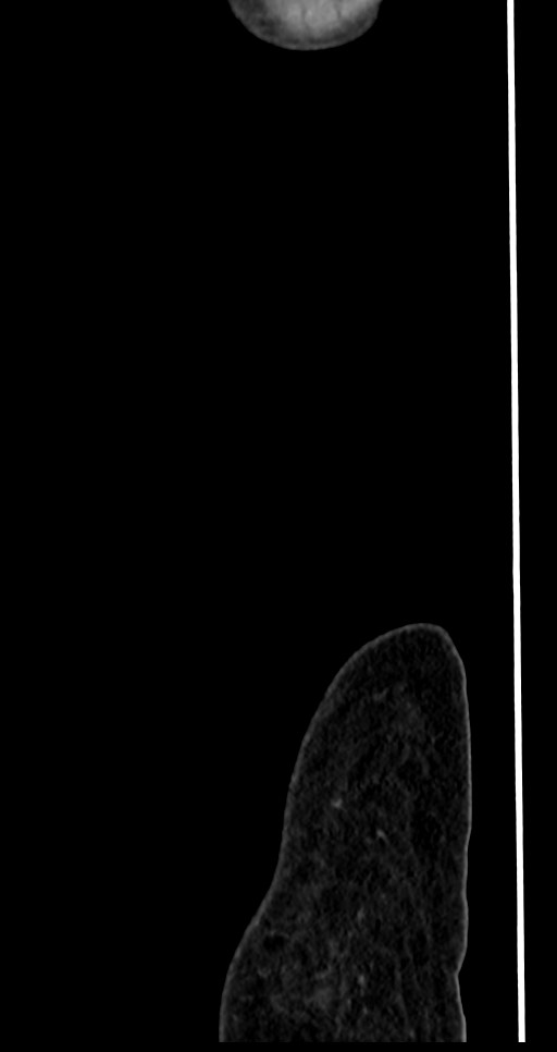 Abdominal wall and retroperitoneal tuberculosis (Radiopaedia 88137-104729 Sagittal C+ portal venous phase 149).jpg