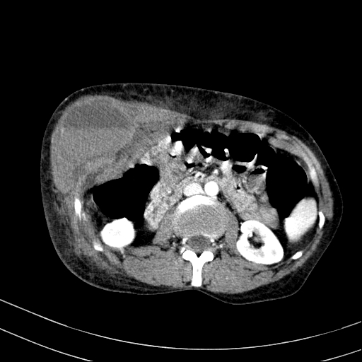 Abdominal wall hematoma with active bleeding (Radiopaedia 83915-99117 Axial renal cortical phase 34).jpg