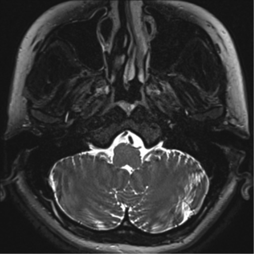File:Abducens nerve palsy (Radiopaedia 51069-56648 Axial T2 fat sat 1).png