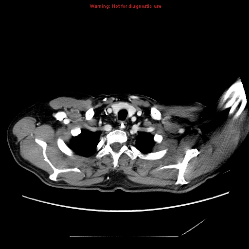 Aberrant right subclavian artery (Radiopaedia 9379-10071 Axial C+ arterial phase 7).jpg