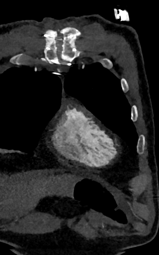 Accessory left atrial appendage (Radiopaedia 81987-95968 Coronal C+ arterial phase 3).jpg