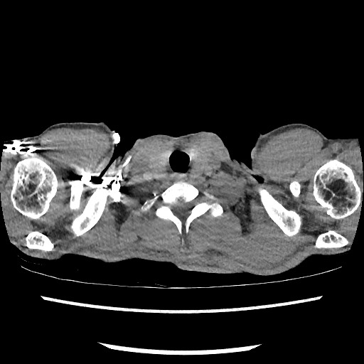Accessory left horizontal fissure with lingular pneumonia (Radiopaedia 53763-59843 Axial C+ CTPA 1).jpg
