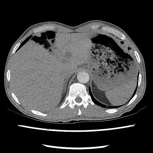Accessory left horizontal fissure with lingular pneumonia (Radiopaedia 53763-59843 Axial C+ CTPA 83).jpg